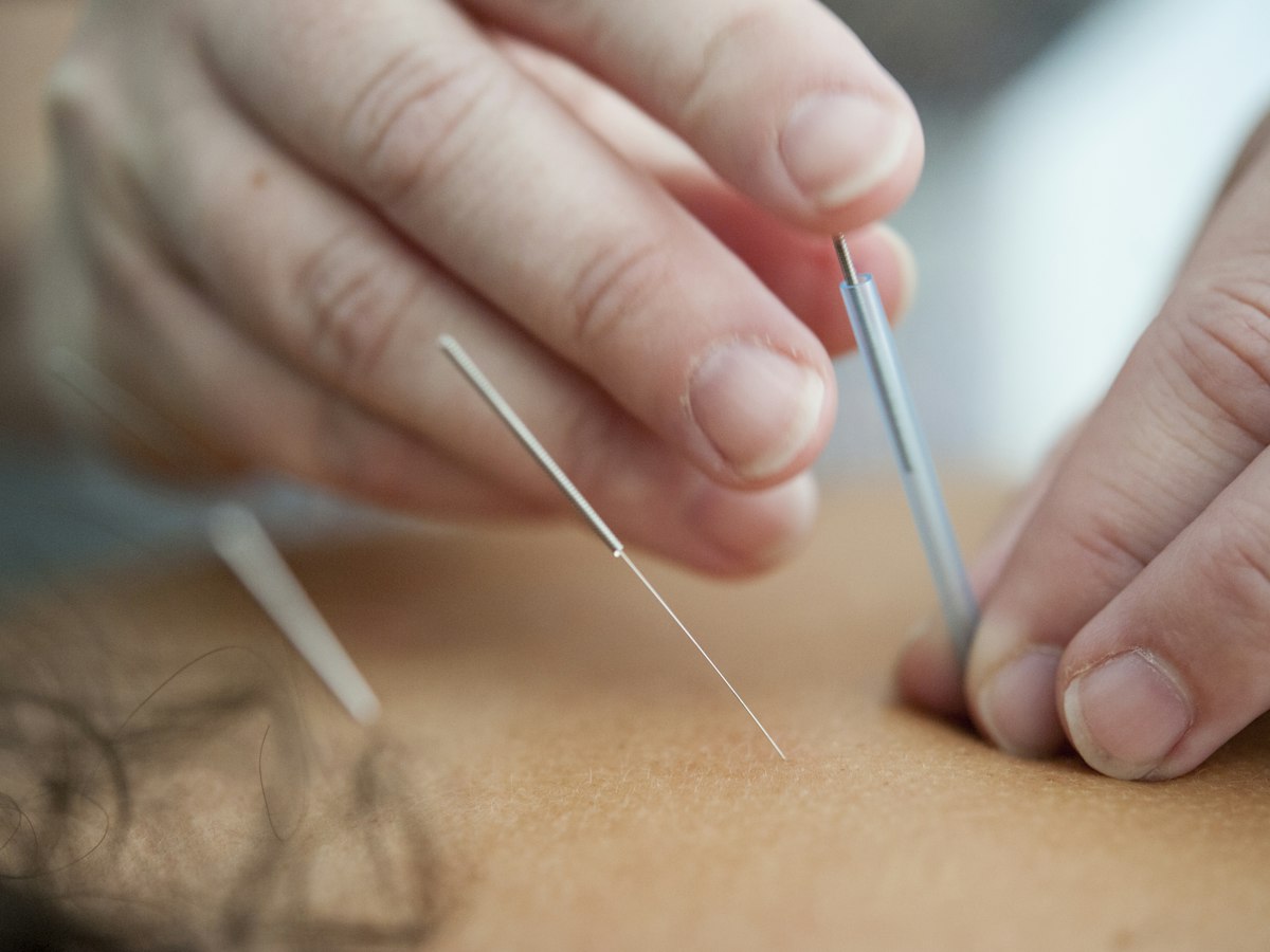 A practitioner placing a fine acupuncture needle